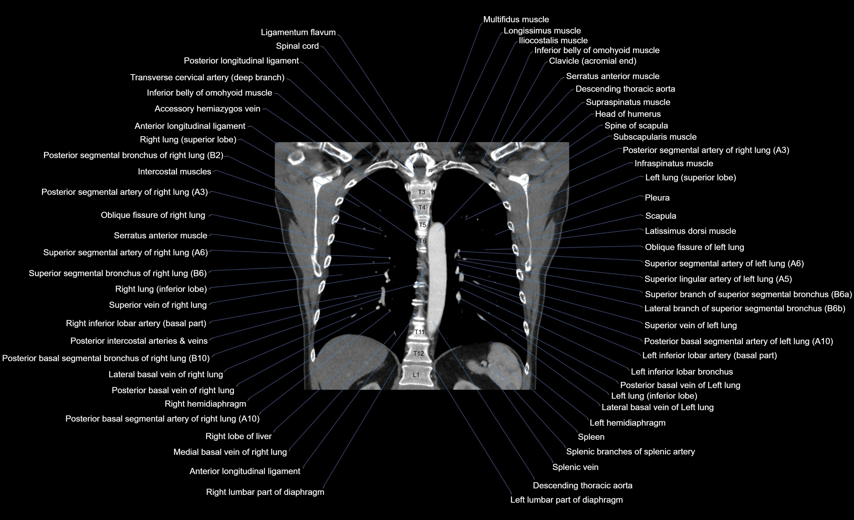 CT chest (thorax) soft tissue window labelled coronal cross sectional anatomy radiology image-00043.webp